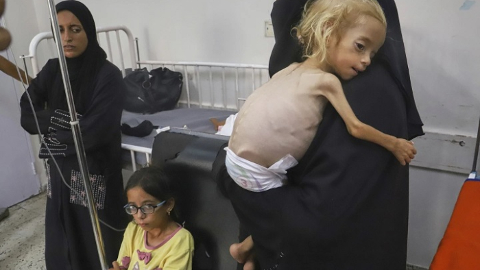 Gazze’de yetersiz beslenme ölümleri artıyor